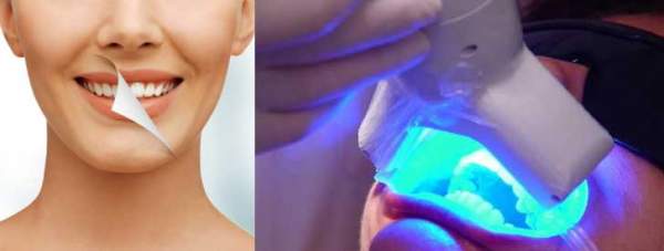 Clareamento Dental  