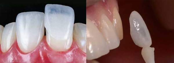 Odontologia Estética ( lentes de contato, facetas )